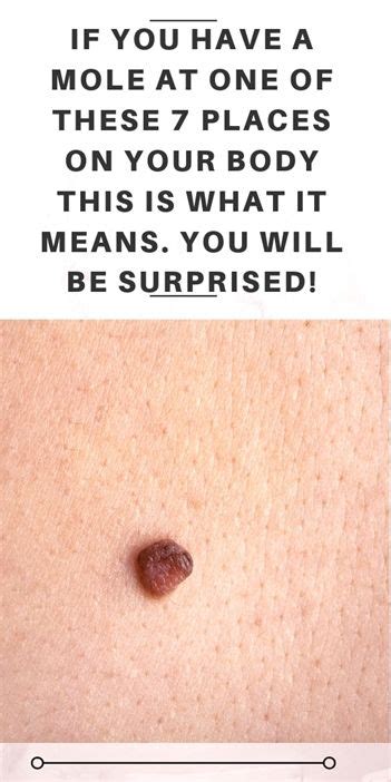 So Do You Want To Know What Do Your Moles Mean Read This Article In