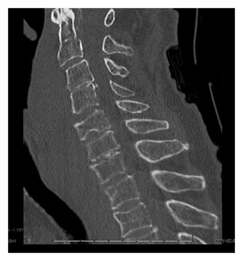 Ct Soft Tissue Of The Neck Without Contrast Showing Prevertebral Soft