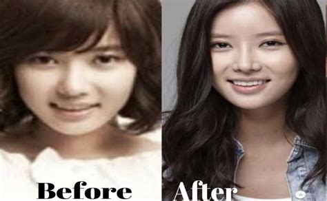 Im Soo Hyang Plastic Surgery Before And After