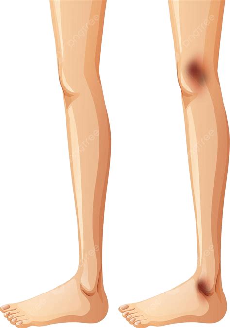 Human Legs And Bruise On White Background Ache People Background Vector