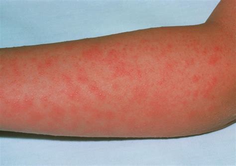 Scarlet Fever Rash On A Patients Arm Photograph By Science Photo Library