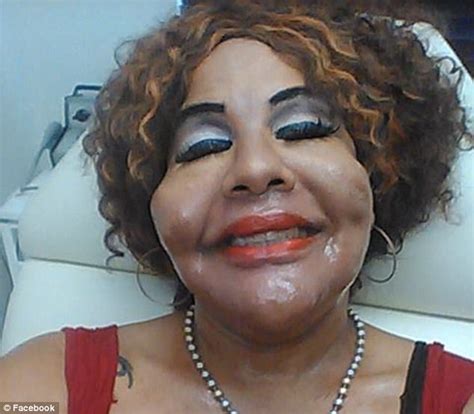 Transgender Woman Who Injected Cement Into Buttocks Daily Mail Online