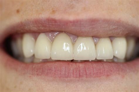 Teeth Whitening Preston Camden Place Dental Practice