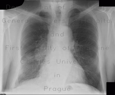 Radiology Case Lung Tumour Hilar Lymphadenopathy