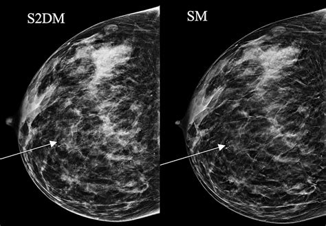 Cureus Could Breast Tomosynthesis With Synthetic View Mammography Aid