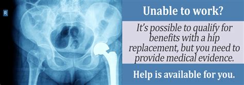 Medical Criteria Needed To Qualify With Hip Replacement Disability