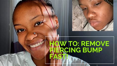 How To Get Rid Of A Piercing Bump Fast Within Weeks Or Even Days Youtube
