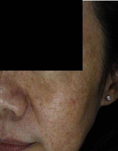 Stop Doing Pico Laser On Melasma The Ogee Clinic 2022