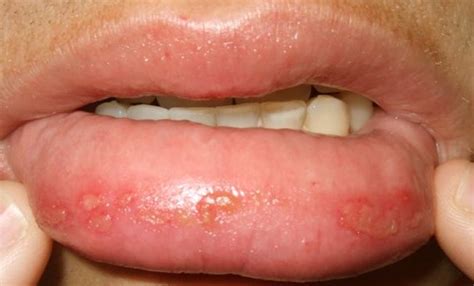 Bumps On Lips Causes Treatments And More Vrogue Co