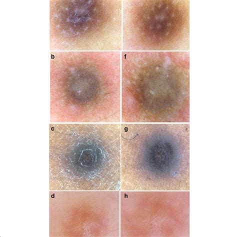 A D Classic Dermoscopic Patterns Of Common Fibrous Dermatofibroma