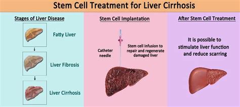 Liver Cirrhosis Final Stages