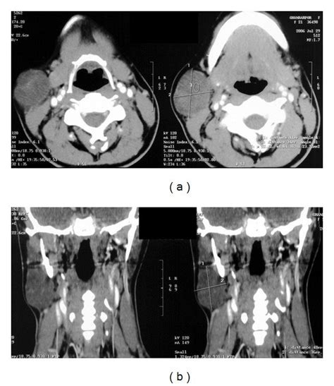 Contrast Enhanced Ct Scan In Axial Views Of Neck A 36 × 48 Mm Soft
