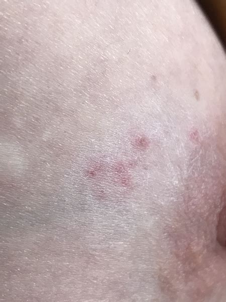 Red Spots On Breast Mumsnet