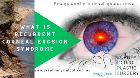 Faq What Is Recurrent Corneal Erosion Syndrome With Dr Anthony Maloof