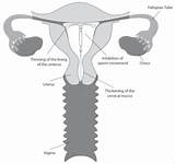 Photos of Information About Iud Birth Control