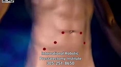 Robotic Prostatectomy Overview Dr Sanjay Razdan Youtube