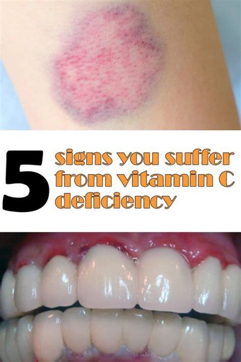 5 Signs You Suffer From Vitamin C Deficiency Vitamins Vitamin C