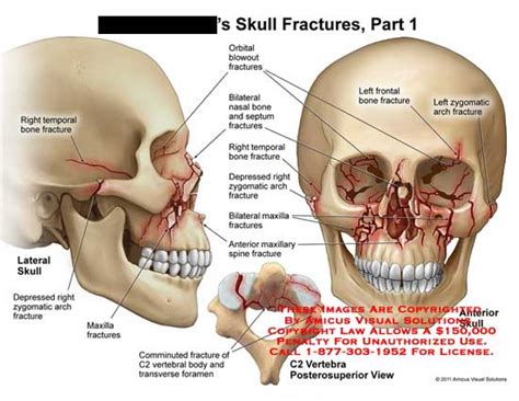 AMICUS Illustration Of Amicus Injury Skull Fractures Part Temporal Bone Depressed Zygomatic