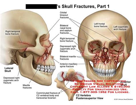 The internal nasal septum separates the nasal cavity into two nostrils. Medical Exhibits, Demonstrative Aids, Illustrations and Models