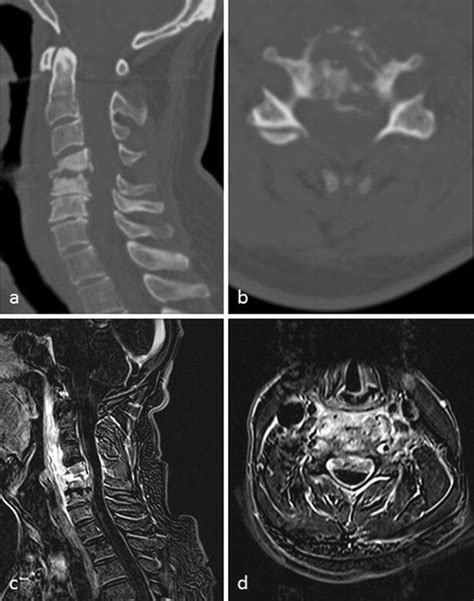 Preoperative Ct Scan In Sagittal A Axial B Planes As Well As