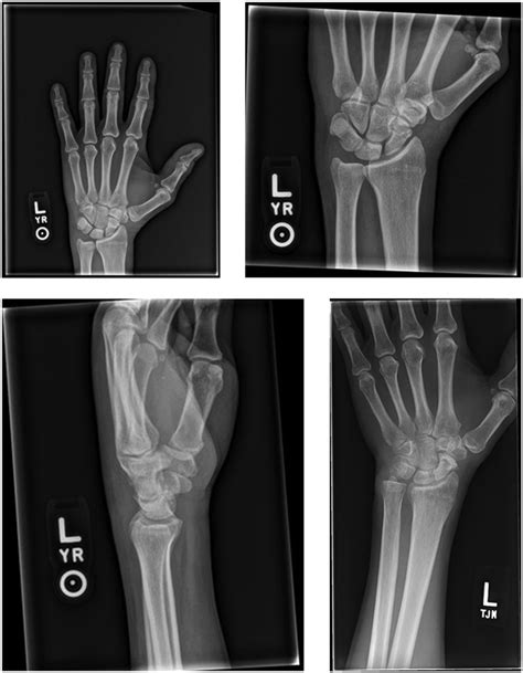 X Rays Of The Left Hand And Wrist At 25 Year Follow Up Showing