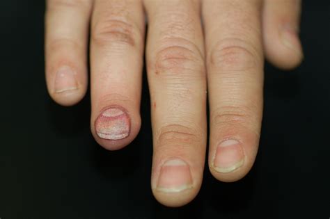 Fingernail Problems Pictures Pictures Photos