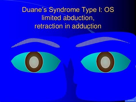 Duanes Retraction Syndrome