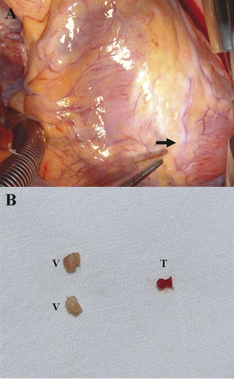 Figure 2 From Mitral Valve Surgery With Surgical Embolectomy For Mitral