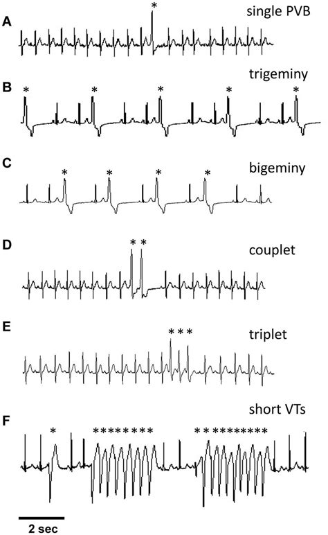 Typical Experimental Ecg Recordings Showing The Different Arrhythmias