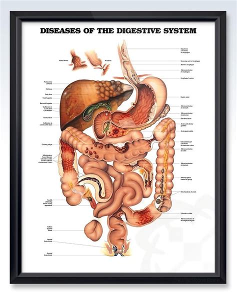 Diseases Of The Digestive System Chart 20x26 In 2020 Digestive System