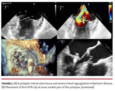 Treating Mitral Valve Prolapse In Barlows Disease By Creation Of A