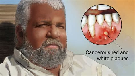 Oral Cancer Or Oral Cavity Cancer Dr Nechupadam Dental Clinic