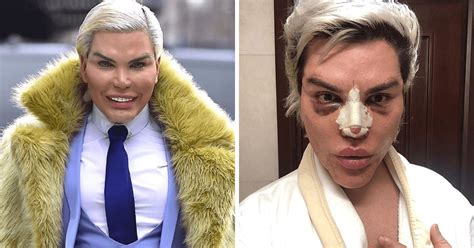 Human Ken Doll S Nose Is Collapsing So He S Having Another Surgery