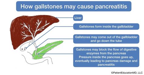 How Gallstones May Cause Pancreatitis Gallstones Bile Duct Gallbladder