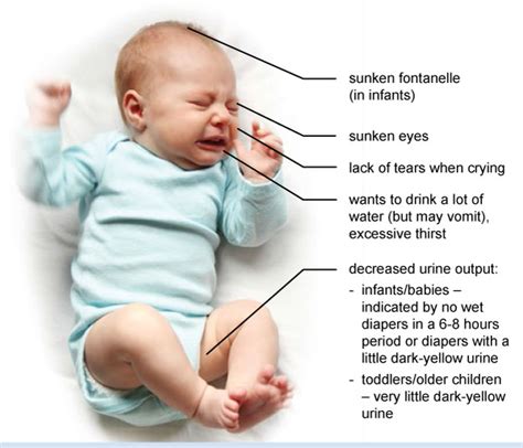 Dehydration Signs In Babies