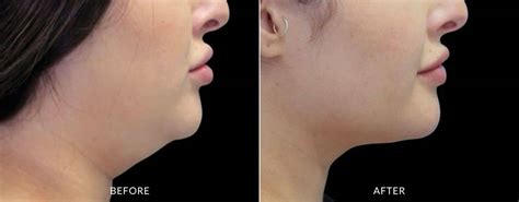 Coolsculpting Chin Reduce Double Chins And Neck Fat