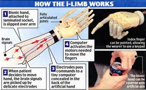 Prosthetics Industry Revolutionised With 3d Printed Limbs And Hands