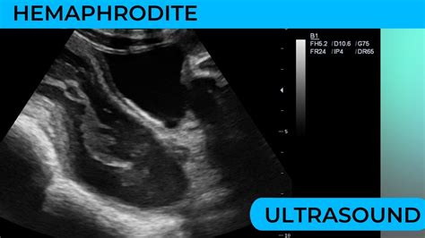 Hermaphrodite Both Male And Female Genitalia On Ultrasound Scan YouTube
