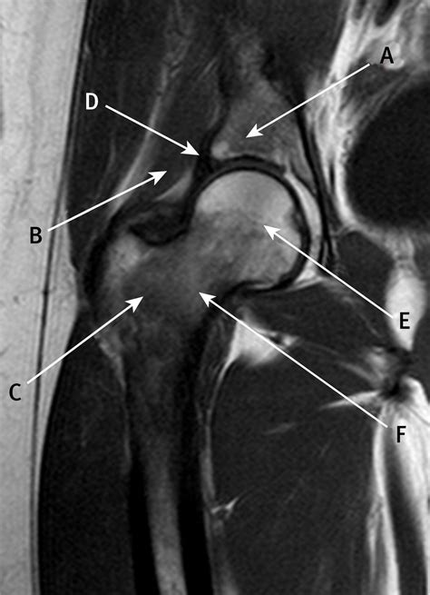 Coronal T2 Weighted Magnetic Resonance Imaging Of The Hip The Bmj