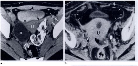 Figure 3 From Ct Anatomy Of The Female Pelvis A Second Look