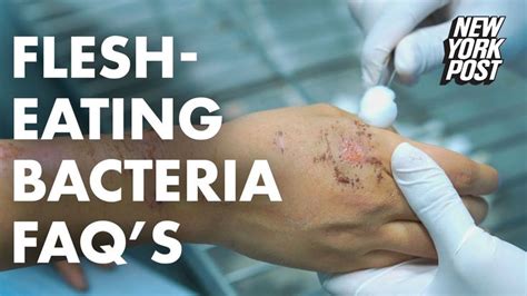 What To Know About Flesh Eating Bacteria This Summer Flesh Eating Flesh Eating Bacteria Bacteria