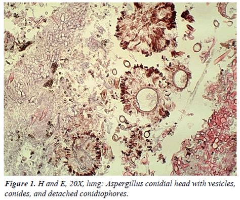 An Incidental Non Invasive Aspergillosis An Autopsy Case Report