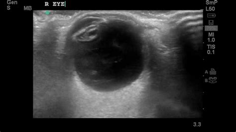 Ocular Ultrasound Posterior Vitreous Detachment Youtube