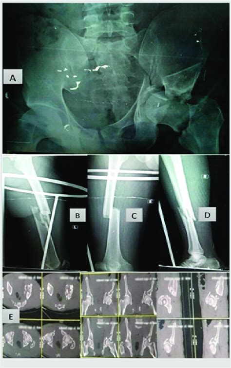 Pre Operative Radiographs A Pelvis Anteroposterior Ap Radiograph