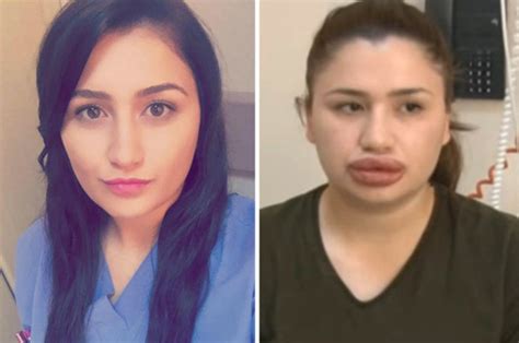 Nurse Could Lose Her Lips After Botched Injection Daily Star