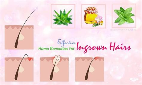 These cysts can be painful buried deep under skin. 16 Effective Home Remedies For Ingrown Hairs Cyst