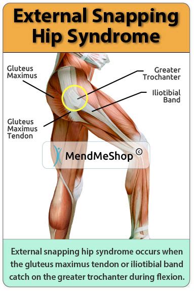 Snapping Hip Syndrome Information And Treatments