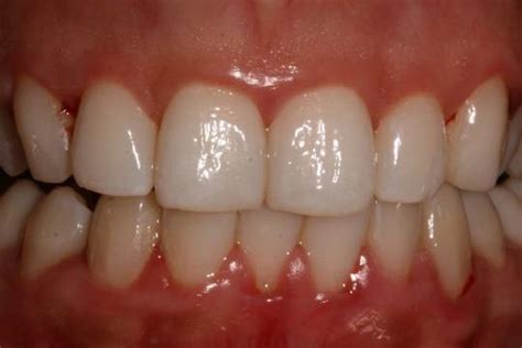 Effective Methods To Keep Gums Healthy Orissapost
