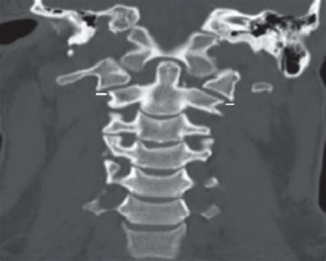 Jefferson Fracture Radiology Key