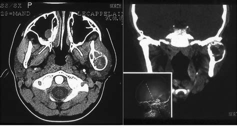 Figure 4 From Aneurysmal Bone Cysts Of The Head And Neck In Pediatric
